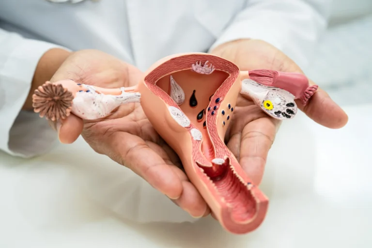 Modelo de un útero para explicar la endometriosis. | Nutricionista Mireya Castiñeiras
